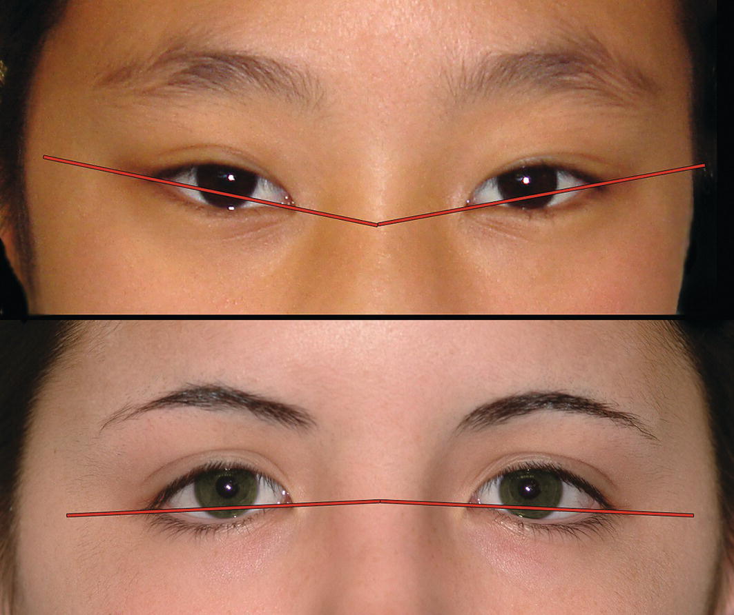 Two closer views of eyes: one at the top featuring a child and the other a woman. Red lines are drawn to indicate the alignment of the eyebrows and eyelids for comparison.