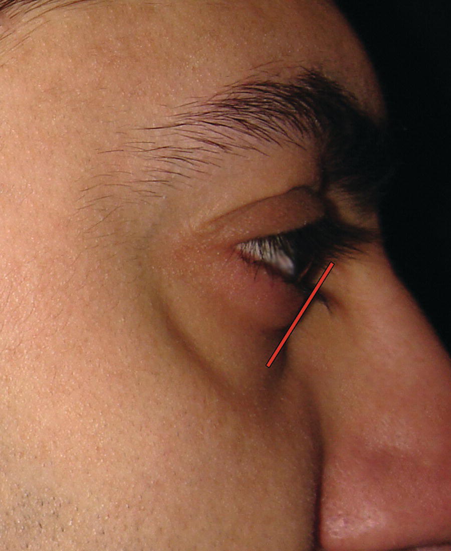 A side profile of a man's face focusing on his eye, with a red line drawn to indicate the angle of the lower eyelid.