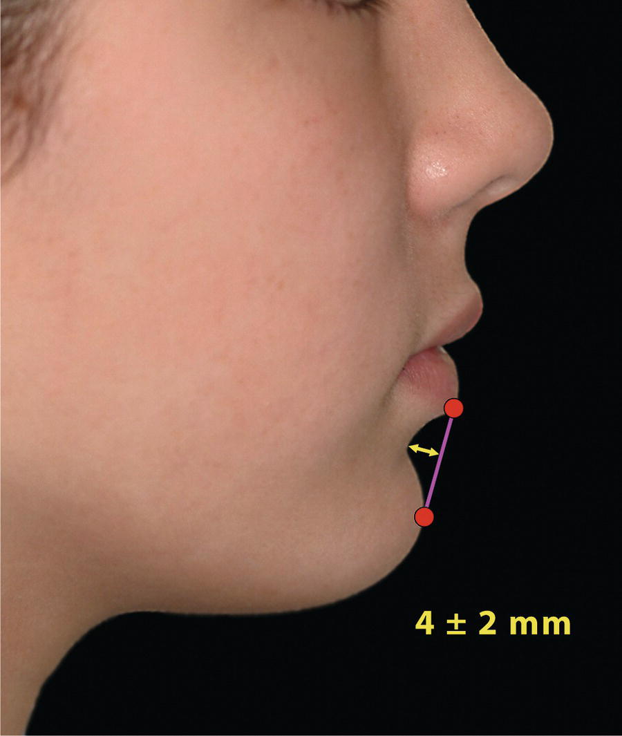 An image of a woman with a red dot on her face indicates the depth of her mentolabial folds.