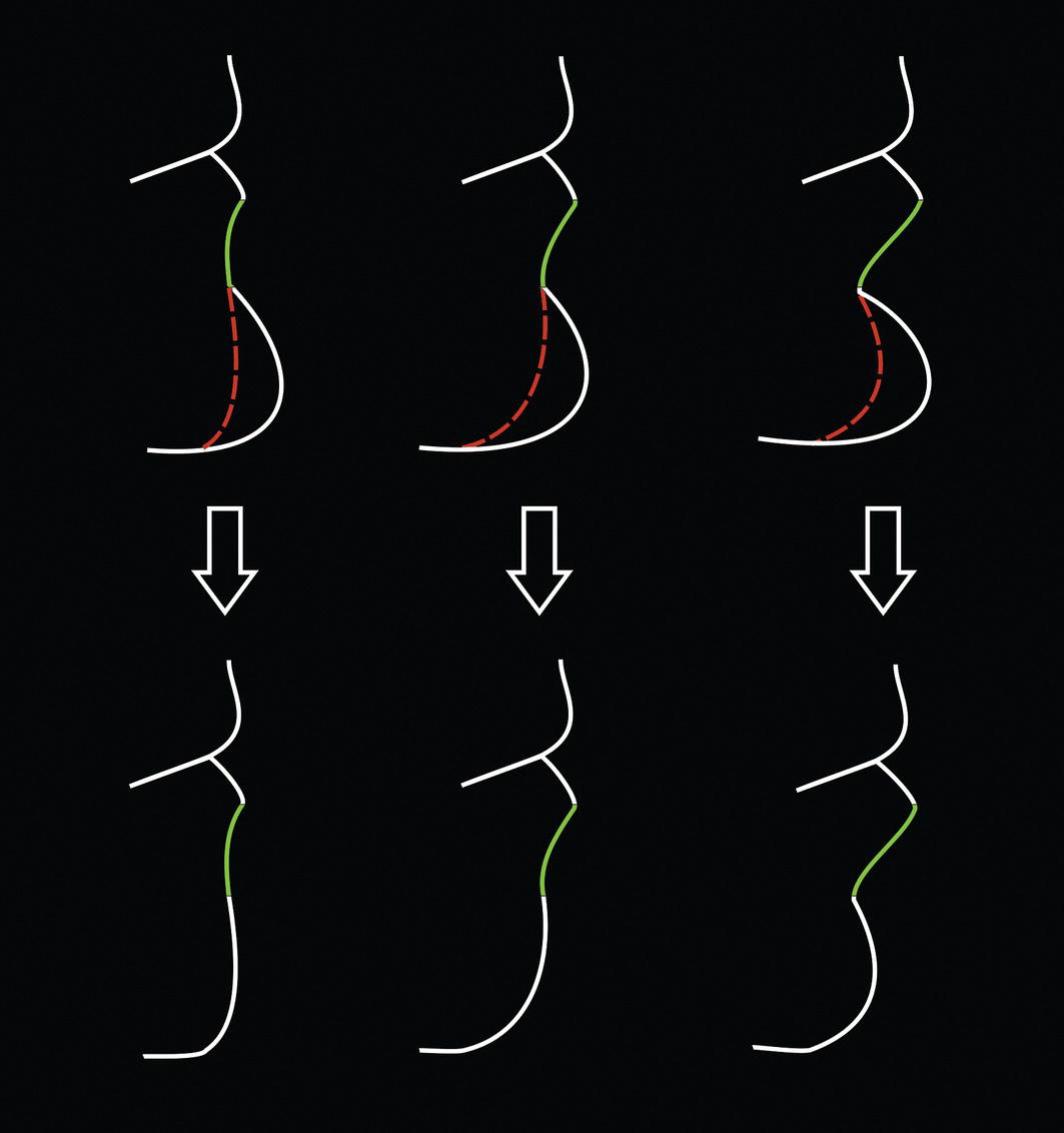 An image of a person in multiple positions indicates lower lip changes after genioplasty.