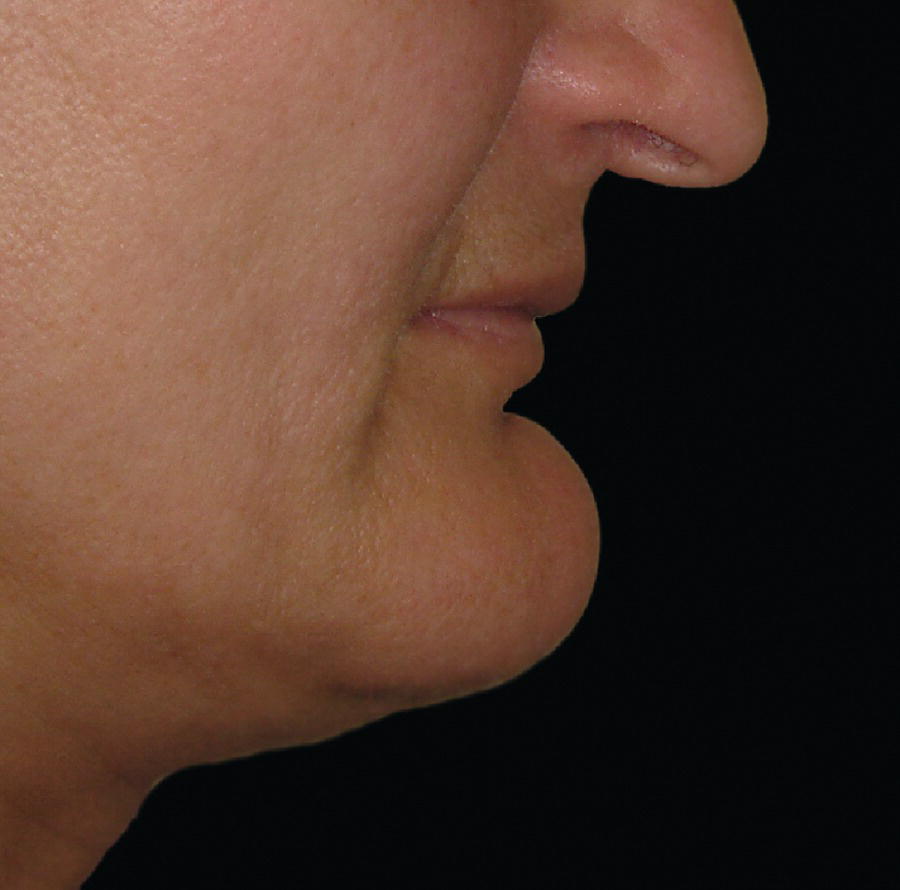An image of a woman with the effects of a neck lift indicates improved chin projection and angle.