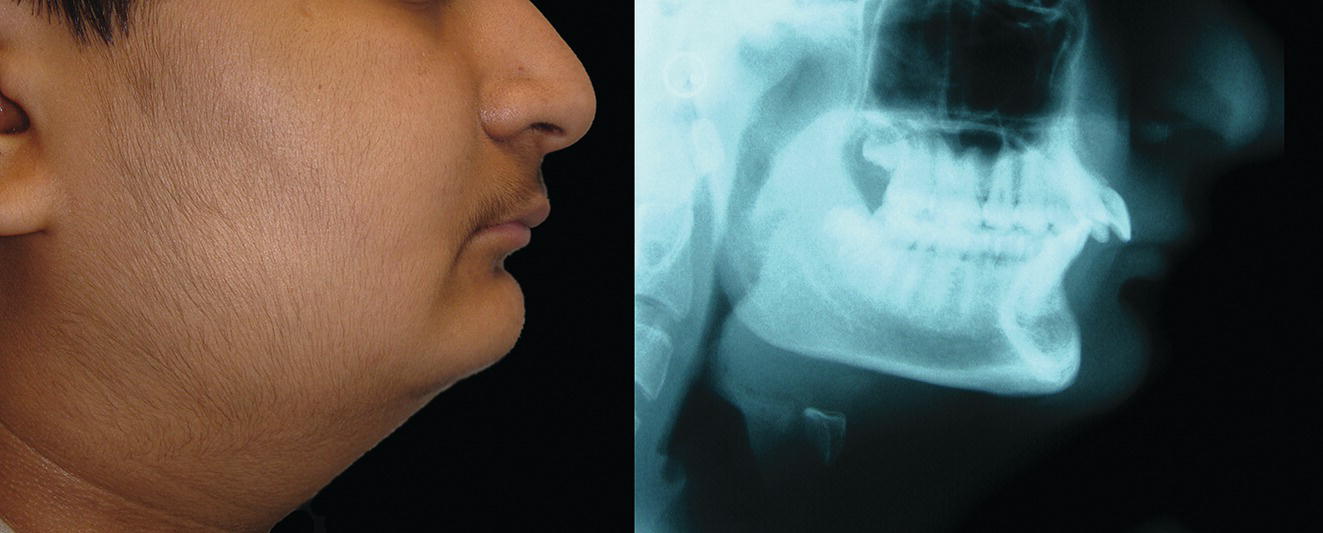 An image of a woman with a missing tooth standing next to an X-ray indicates mandibular deficiency and reduced facial height.