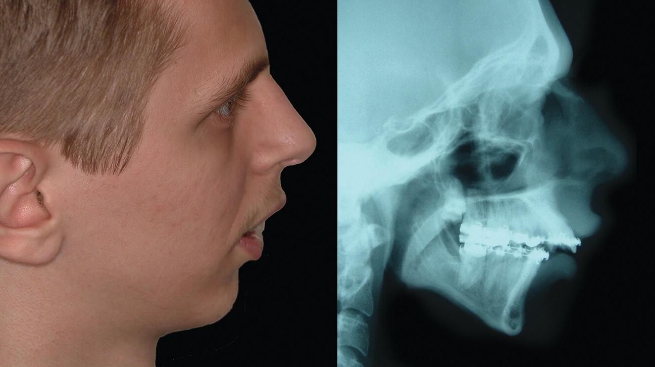 An x-ray of a man with a broken jaw indicates sagittal mandibular deficiency and increased lower anterior facial height.