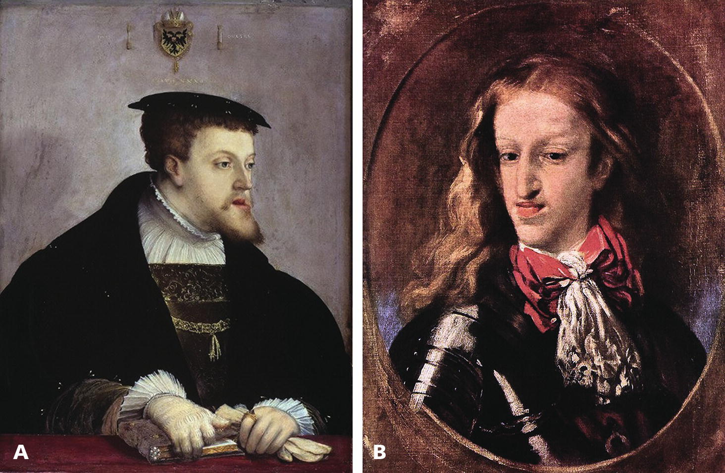 An image features portraits of two notable figures from the Hapsburg dynasty: Charles V, Holy Roman Emperor, and Charles II of Spain. Both portraits highlight the distinctive 'Hapsburg jaw' and protrusive lower lip characteristic of their lineage. The description emphasizes their facial features as well as aspects of their clothing.