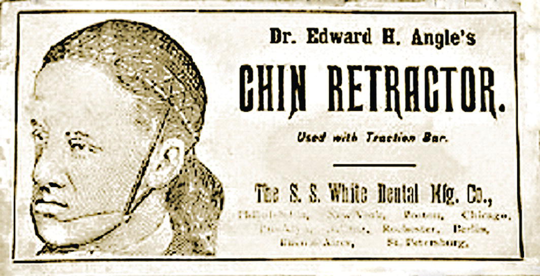 An image features Dr. Edward H. Angle's chin retractor, designed for use with a traction bar in dental procedures. It is associated with the S. White Dental Manufacturing Company. The tags suggest that the content may include elements related to human anatomy, possibly illustrating its application on a man's face or involving related text and font details.