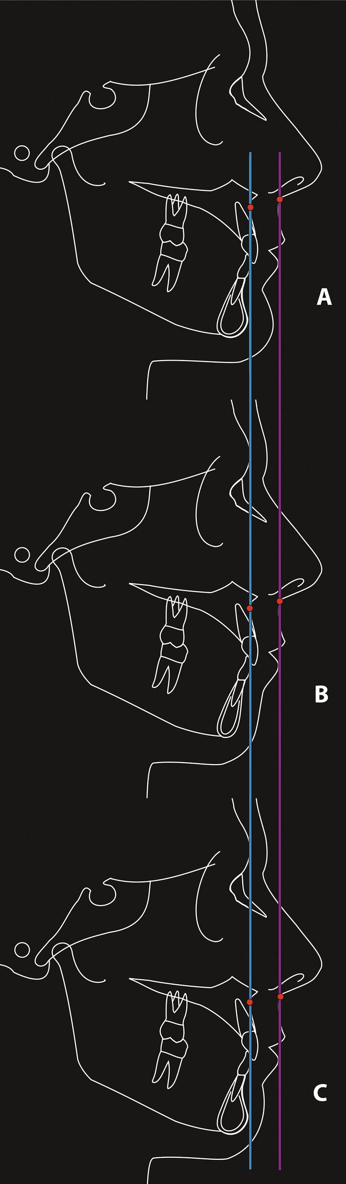 A diagram featuring three labelled parts related to chin prominence. It includes references to normal chin prominence, a horizontal configuration, and reduced thickness of the soft tissue chin pad. The visual elements include sketches and handwritten notes that enhance the understanding of these concepts.