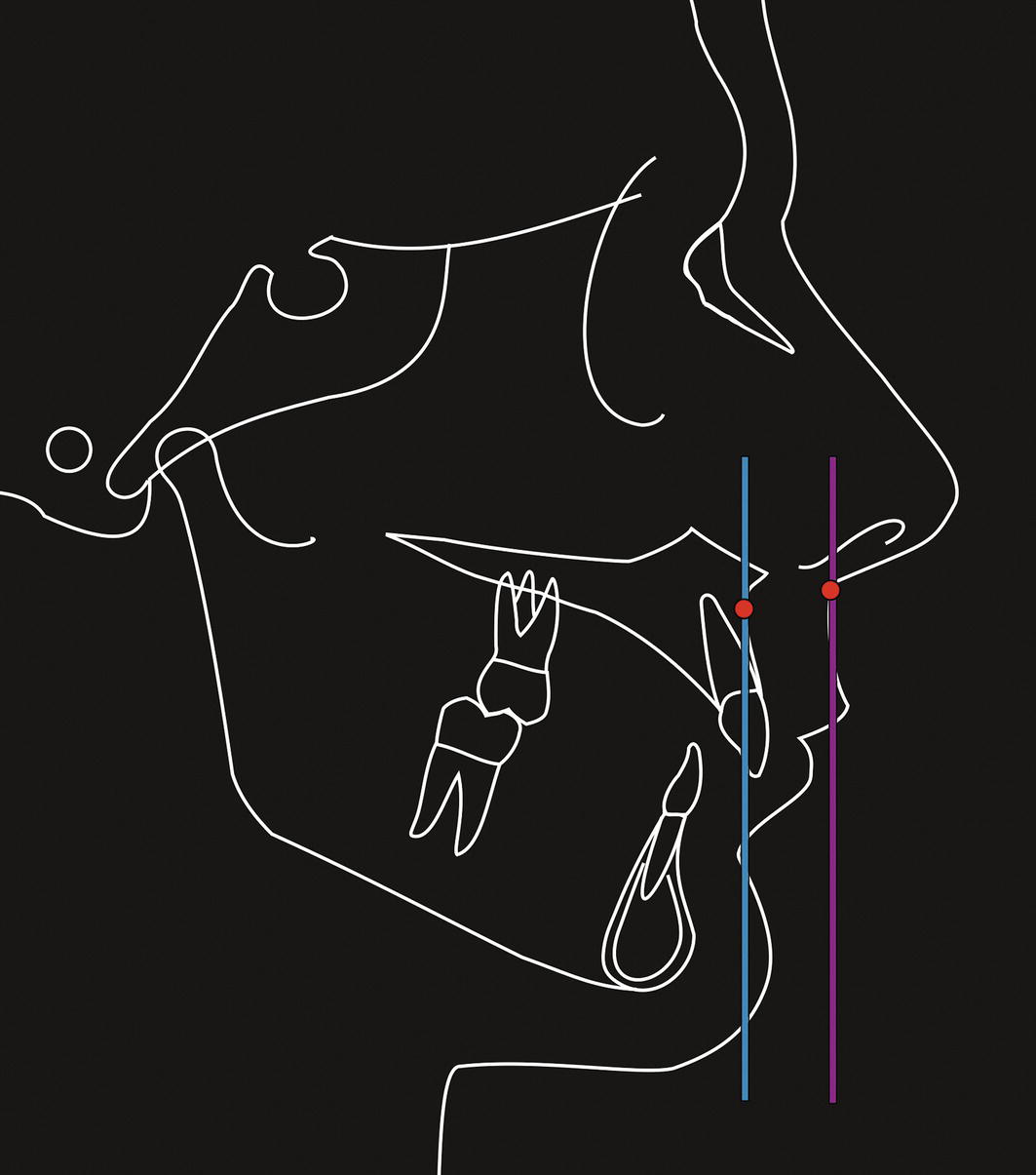 A diagram illustrating sagittal chin deficiency that occurs due to mandibular deficiency. It shows a comparison of normal chin morphology associated with a small or retropositioned mandible. The visual aids are designed to clarify the anatomical aspects involved in this condition.