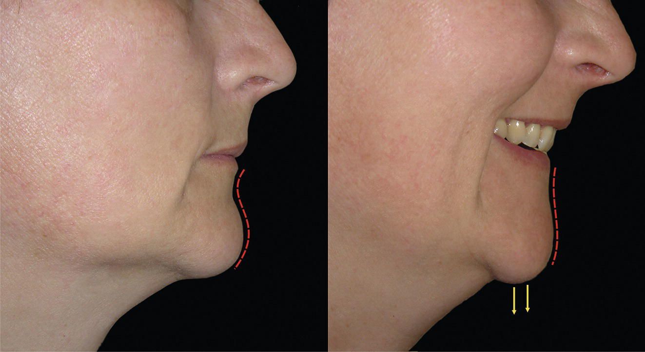 Two photographs presenting data related to facial anatomy. It specifically references ptosis of the soft tissue chin pad, comparing its appearance in repose and during animation.