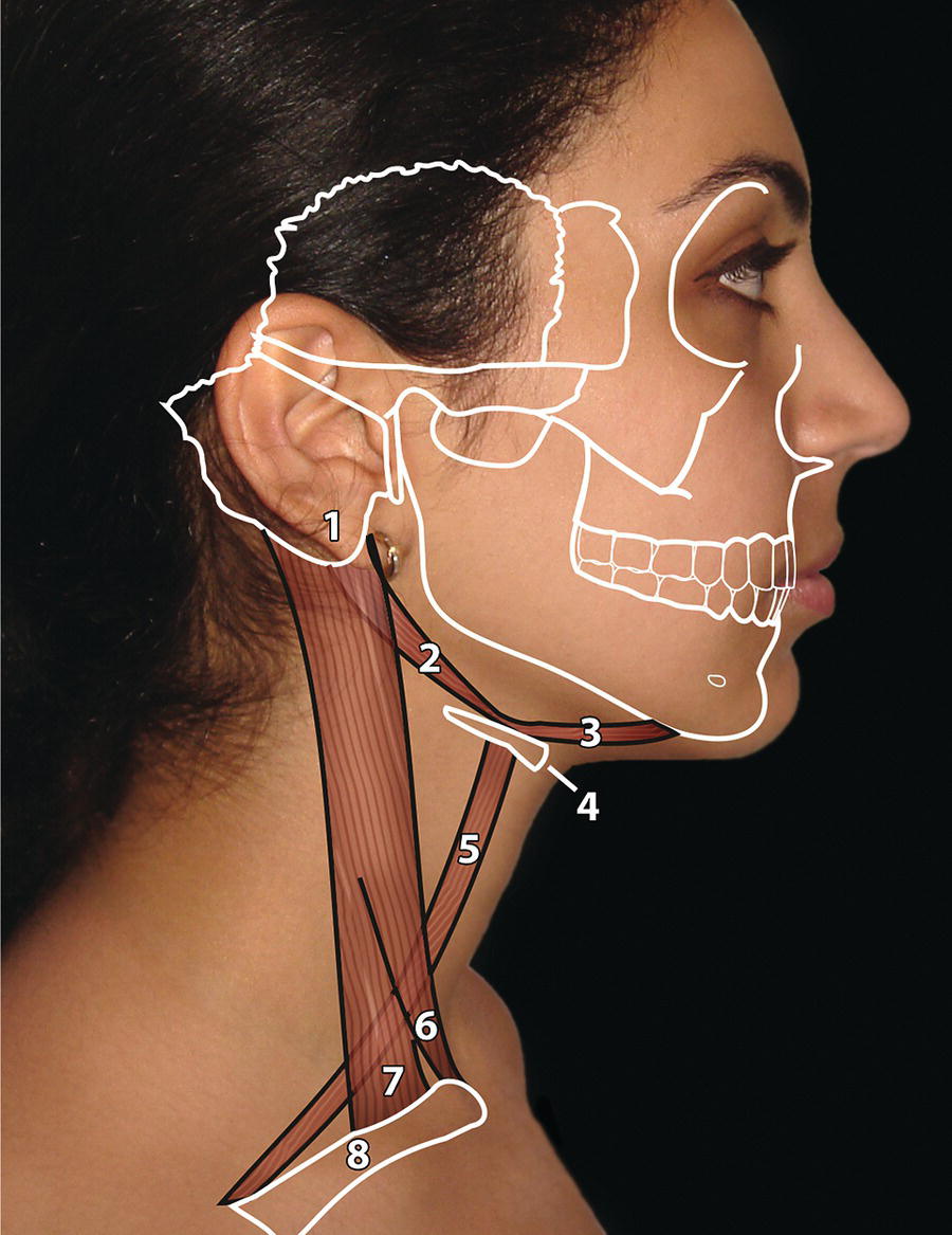 A photograph of the face and neck of a woman with superimposed bony and muscular outlines. The outline of the skull is visible, along with the mastoid process, the posterior and anterior bellies of the digastric muscle, the hyoid bone, the omohyoid muscle, and the sternal and clavicular heads of the sternocleidomastoid muscle. The numbers 1-8 correspond to the different anatomical structures.