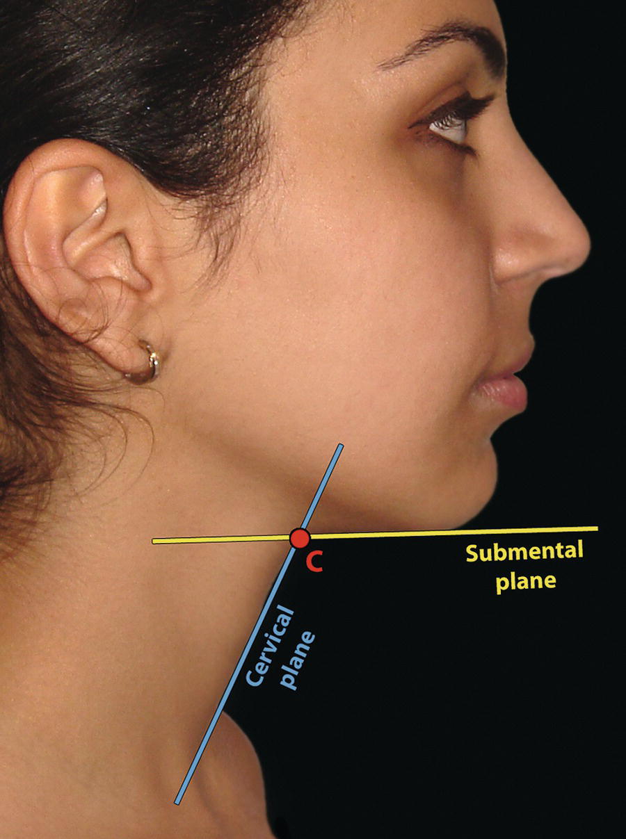 A close-up of a woman's face and neck in profile. The woman has dark hair and is looking straight ahead. The image is labelled with anatomical terms, including "submental plane," "cervical plane," and "cervical point." The submental plane is a horizontal line drawn across the bottom of the chin, while the cervical plane is a diagonal line drawn from the bottom of the chin to the top of the ear.