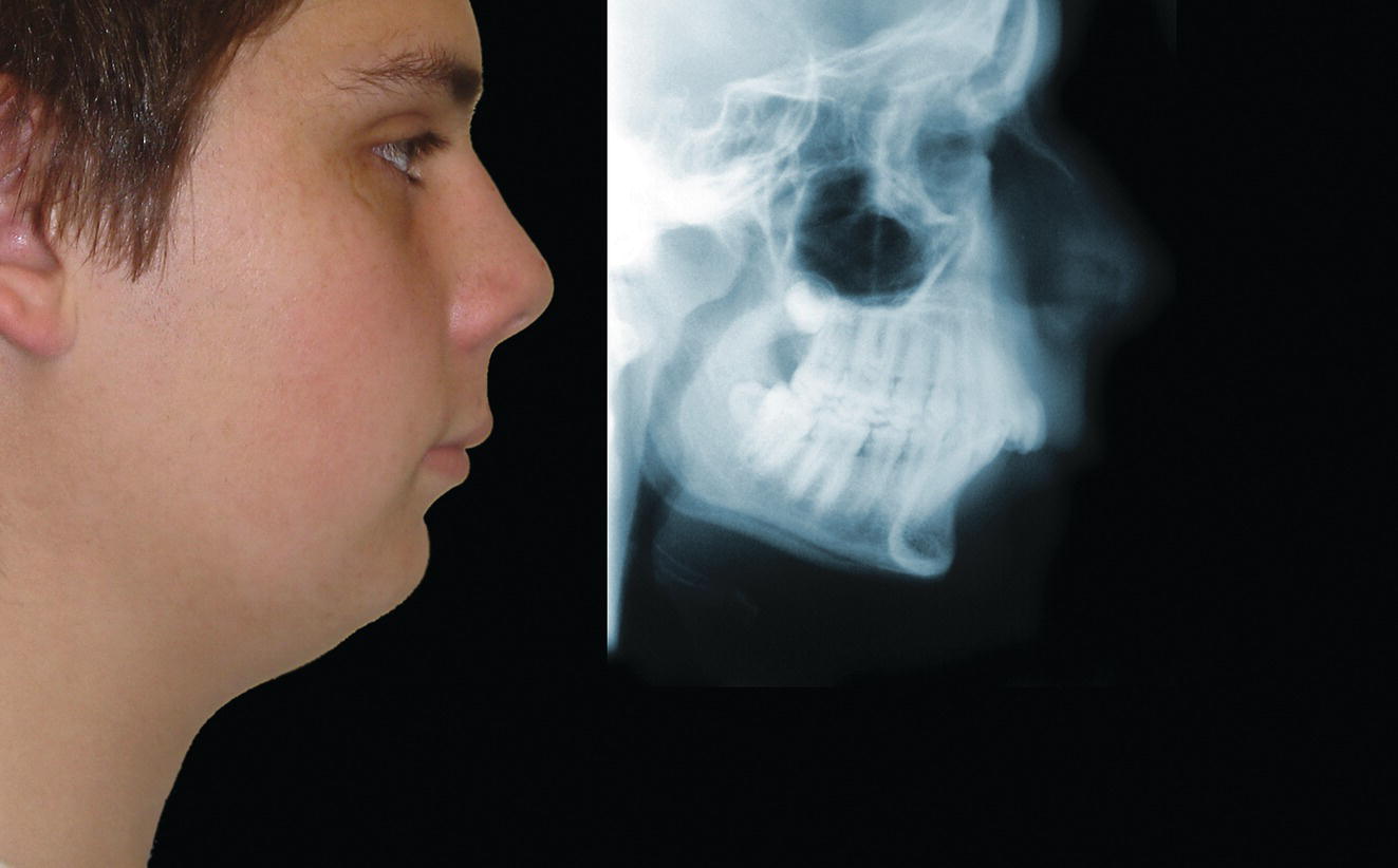 A side profile of a young man's face next to an X-ray of his jaw and teeth. The caption explains that the image depicts a Class II jaw relationship, which is caused by a mandibular deficiency and significant compensatory proclamation of the mandibular incisor teeth. The submental-cervical angle is increased in this case.