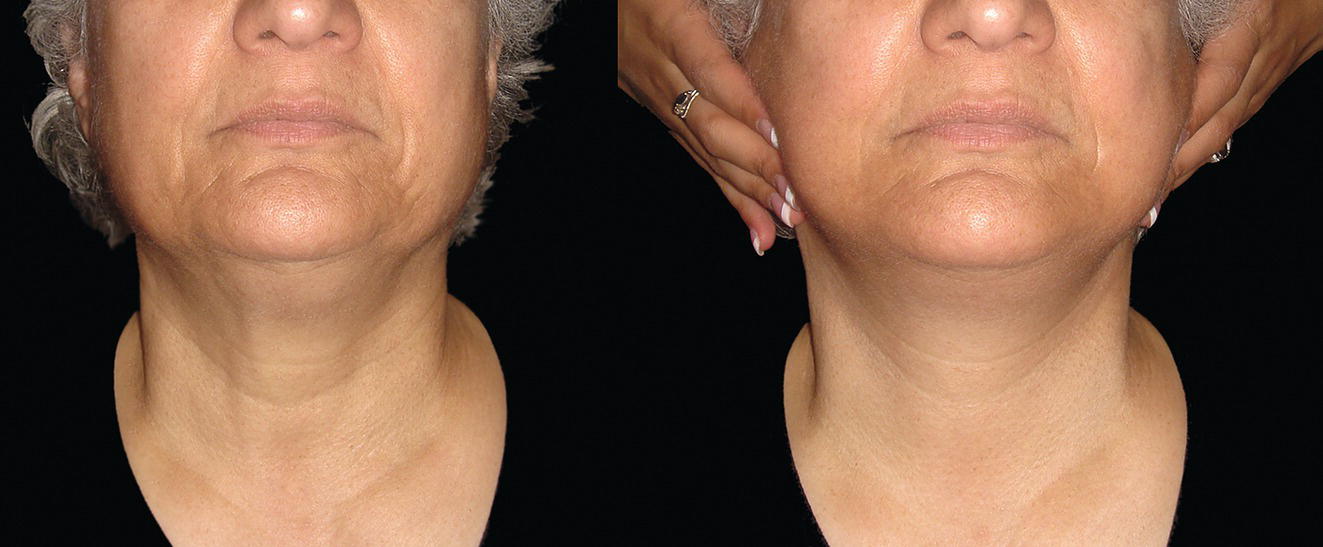 A photograph depicting information related to the Skin laxity test of a woman's face. It includes the skin laxity test, specifically focusing on the neck area. The content emphasizes aspects related to skin and its elasticity.