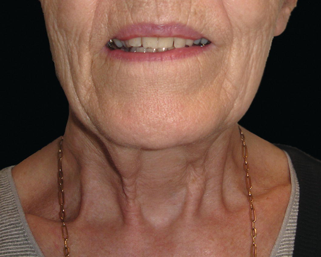 An image features a woman displaying a large smile, highlighting her facial expression. The context also includes information about platysmal bands that may be noticeable in the neck area as one age.