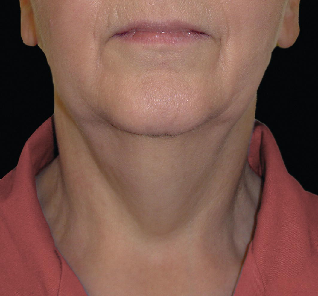 A photograph related to an application, specifically illustrating submental adiposity. It features a close-up of a human face focusing on skin details around the chin, jaw, cheeks, and lips.