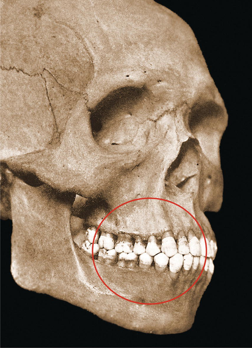 A photograph of human skull. 'Normal' dental occlusion, despite it was the 'ideal' for which orthodontists were trained.