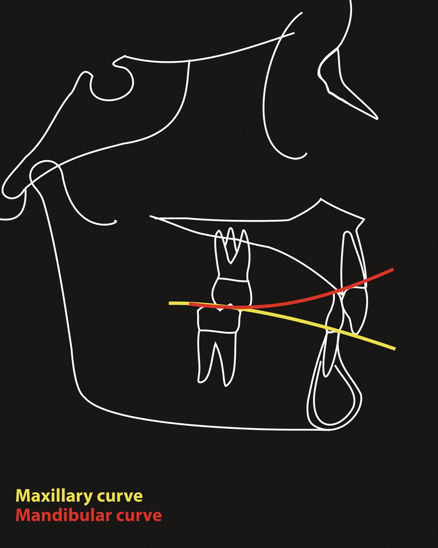 A diagrammatic representation of sagittal occlusal curves: the maxillary and mandibular incisors have overgrown beyond each other, forming a reverse curve in the maxillary arch.