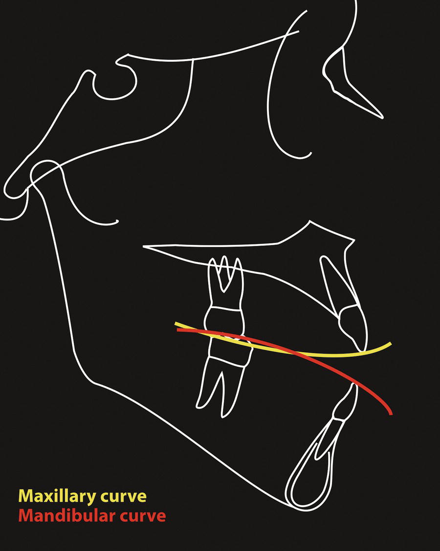 A diagrammatic representation of sagittal occlusal curves. A forward resting tongue posture prevents the maxillary and mandibular incisors from emerging fully.