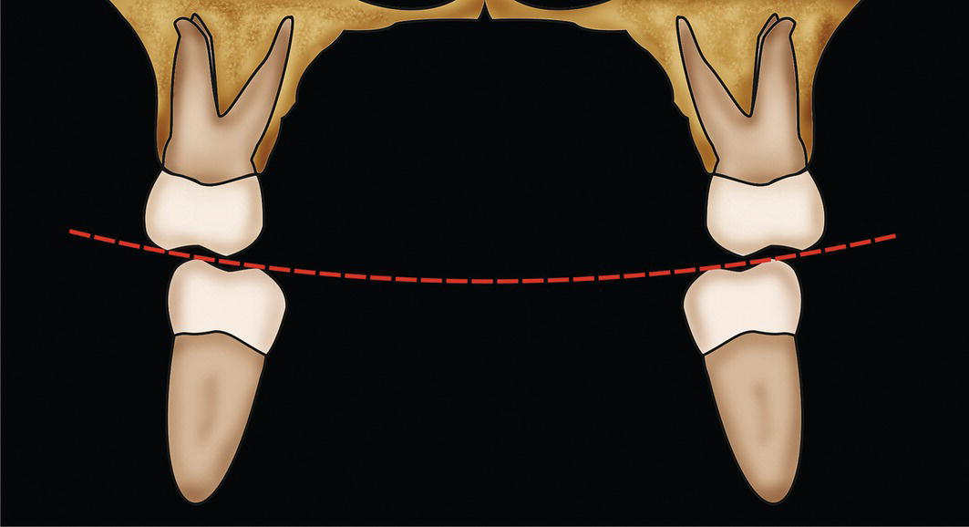 A diagrammatic representation of occlusion teeth. The mediolateral curve of occlusion is also known as the 'curve of Wilson'.