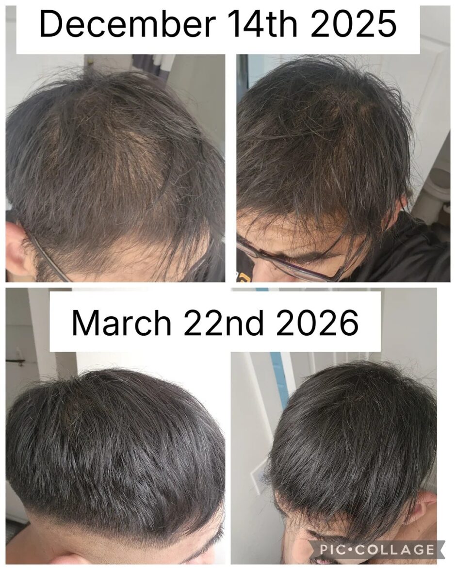 cjc + ipamorelin before and after FROM 208 Lb  172 Lb 24%  12.2% BODY FAT ZERO muscle lost Peptides have been phenomenal. locking in nutrition, tracking macros, training 5x/week, this patient added CJC/Ipamorelin CJC 1295 Ipamorelin Results Timeline: