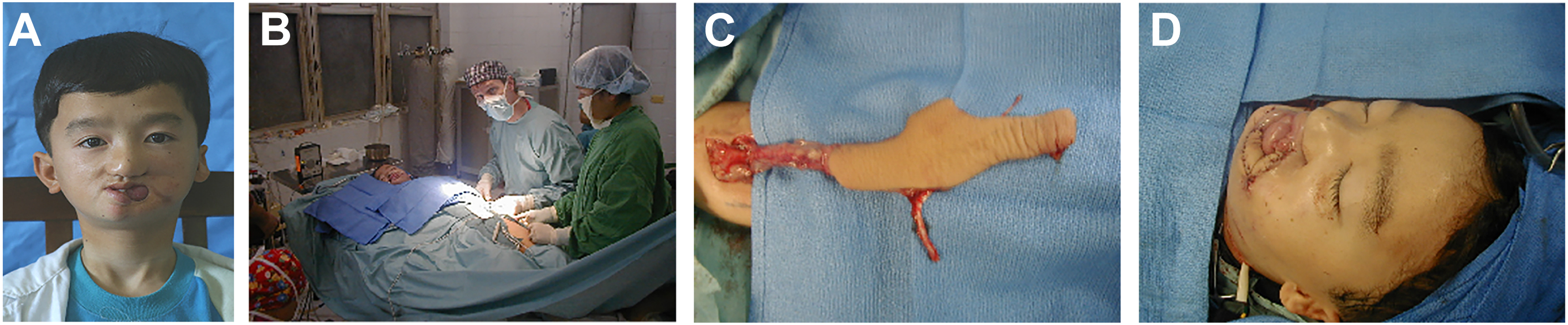 Four photographs show the surgical correction of a left oral commissure defect from Noma using a radial forearm flap to restore lip competence.