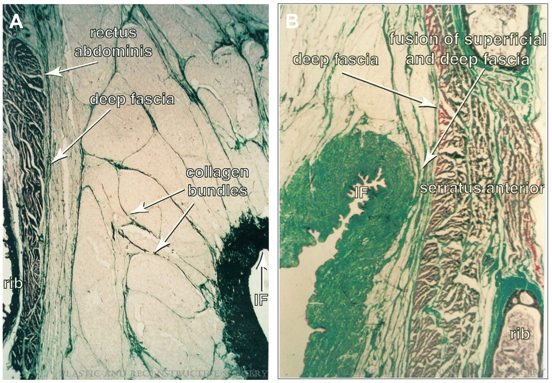 A set of two histology view shows the inframammary fold. The panels show the rectus abdominis, deep fascia, collagen bundles, serratus anterior, and the fusion of superficial and deep fascia.