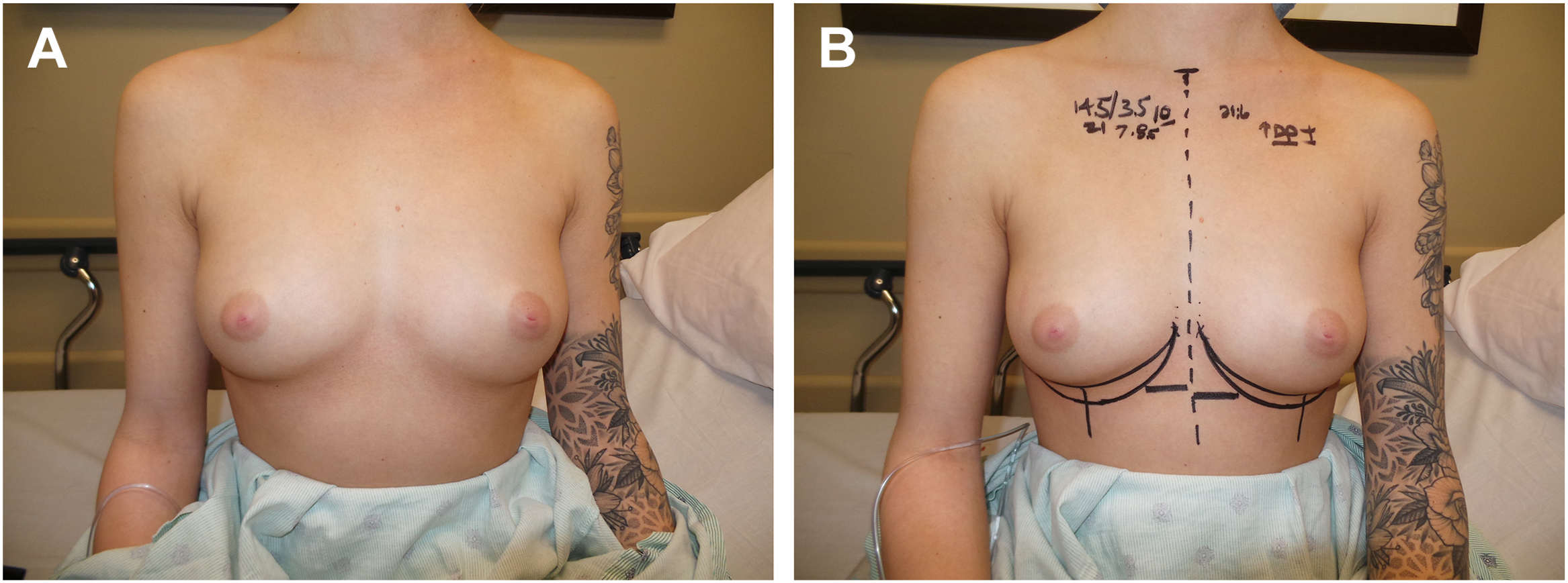 A set of two photographs, A and B, shows a preoperative frontal view of a patient's chest with asymmetry, and a second view with surgical markings to correct the asymmetry.