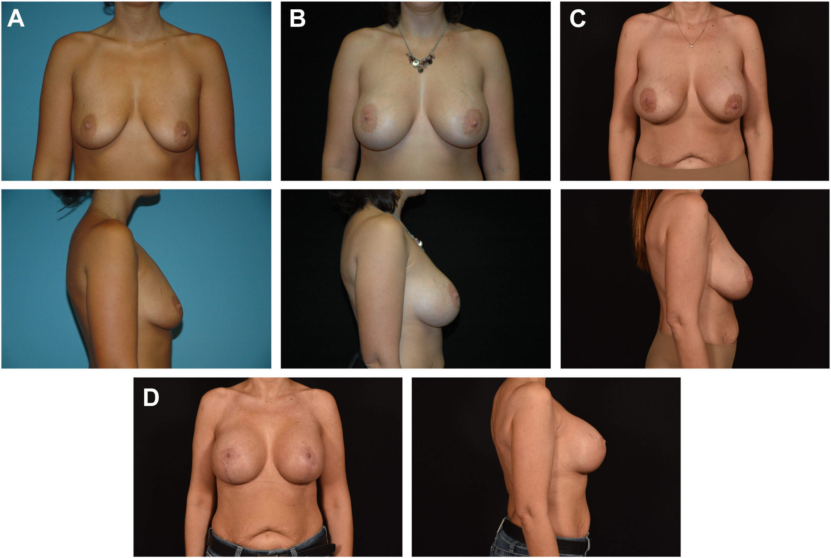 A set of photographs shows a woman before and after multiple breast surgeries in front and side views.