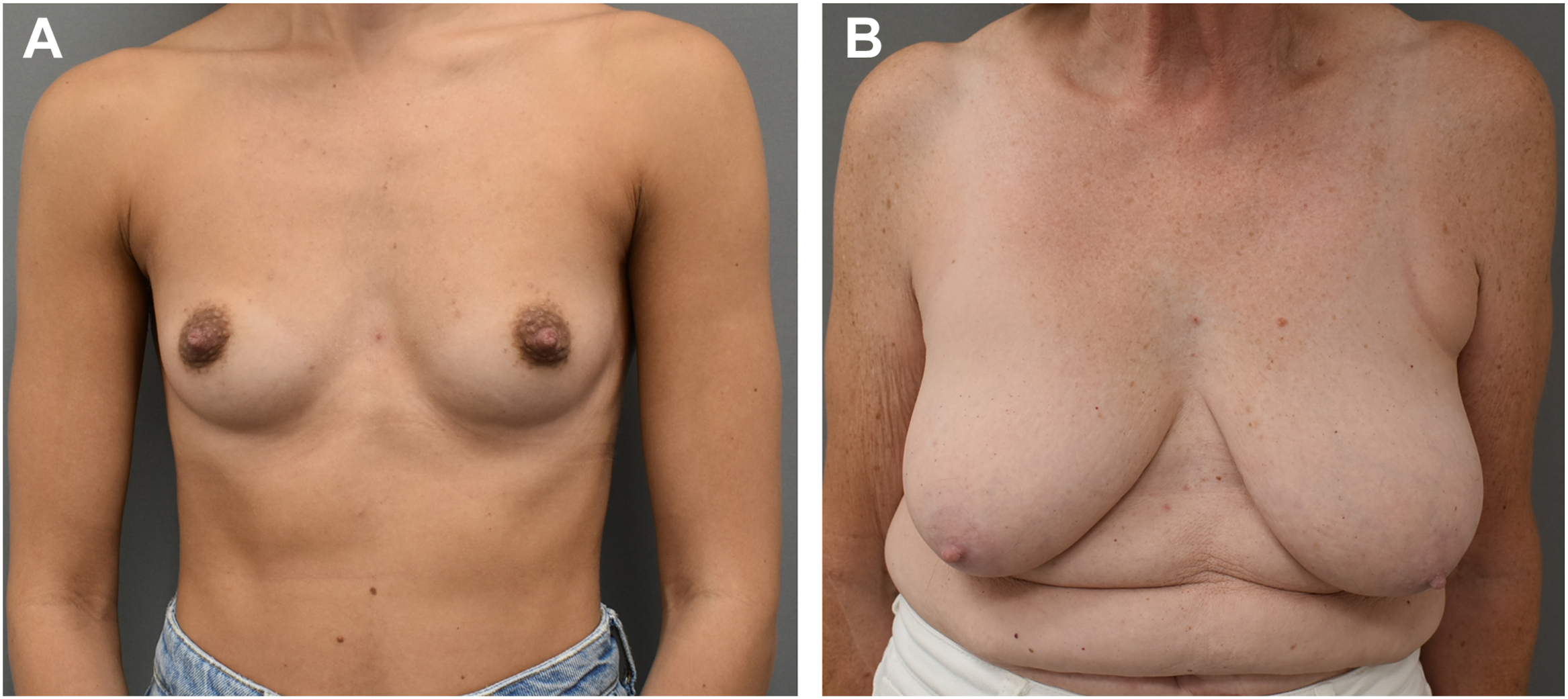 A set of two photographs compares a youthful breast with good shape to an aged breast. The aged breast shows significant skin laxity and ptosis.