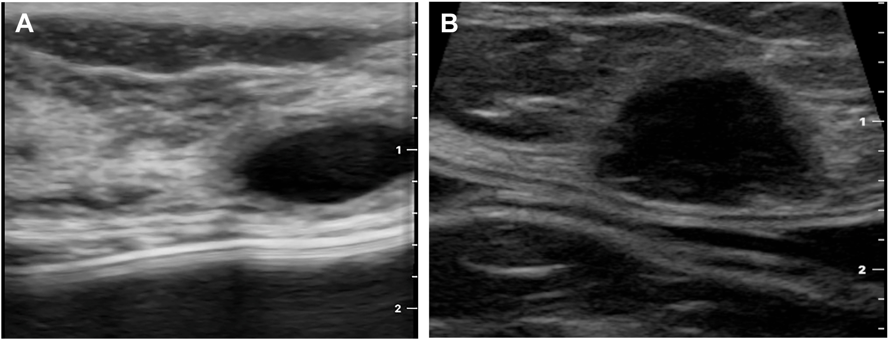 A set of two ultrasound scans compares a benign breast cyst to invasive lobular cancer. The cyst appears as a smooth, dark, anechoic circle, while the cancer appears as a larger, irregular mass.