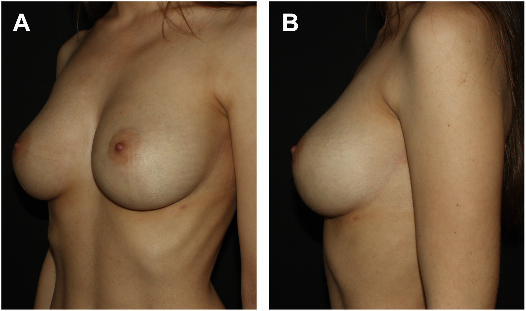 A shows an angled view of one breast with a rounded form and forward-facing nipple. B shows a side view of the same breast with a smooth outward curve from chest wall to tip.
