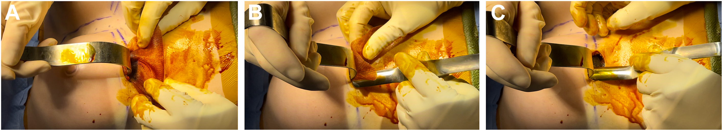 A set of surgical photographs shows gloved hands using retractors and instruments to position a sling within an incision on the chest.
