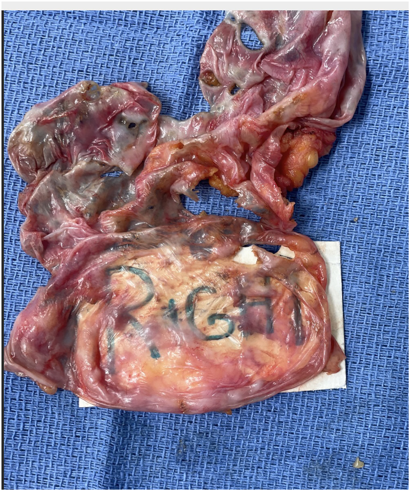 A surgically excised tissue specimen labeled right is placed on a pad against a textured surface.