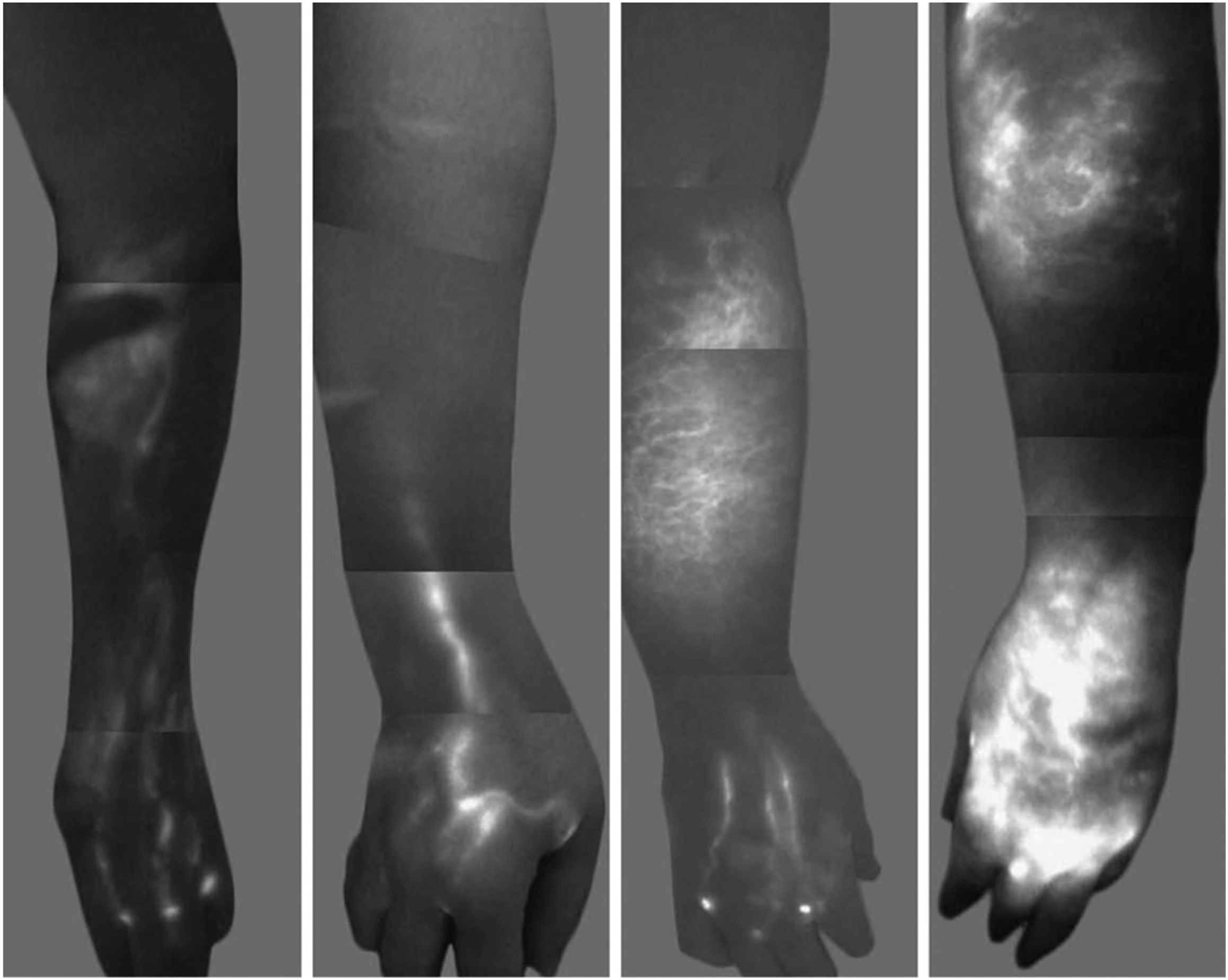 A series of four lymphangiographic photos shows the progressive stages of lymphatic vessel dysfunction and increasing dermal backflow in the arm.