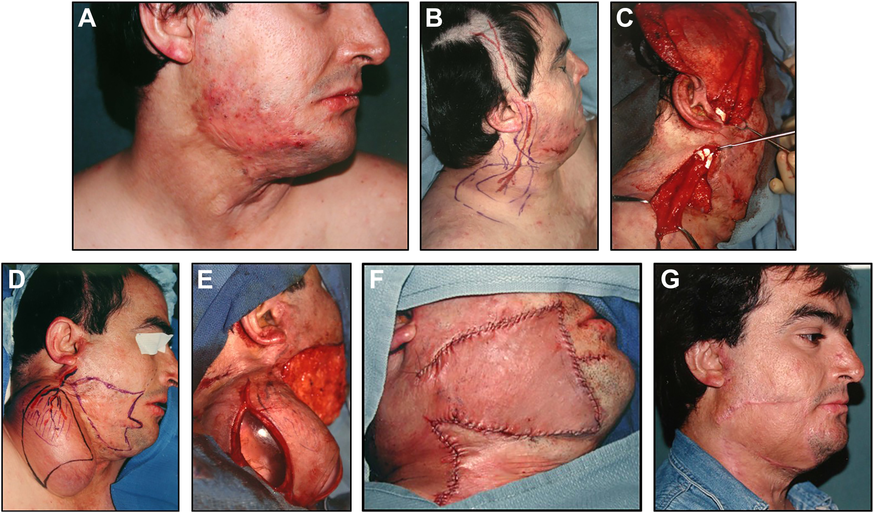 A 7-panel photo series visually documents a staged facial reconstruction, from scarred tissue to final surgical repair using a vascularized tissue flap.