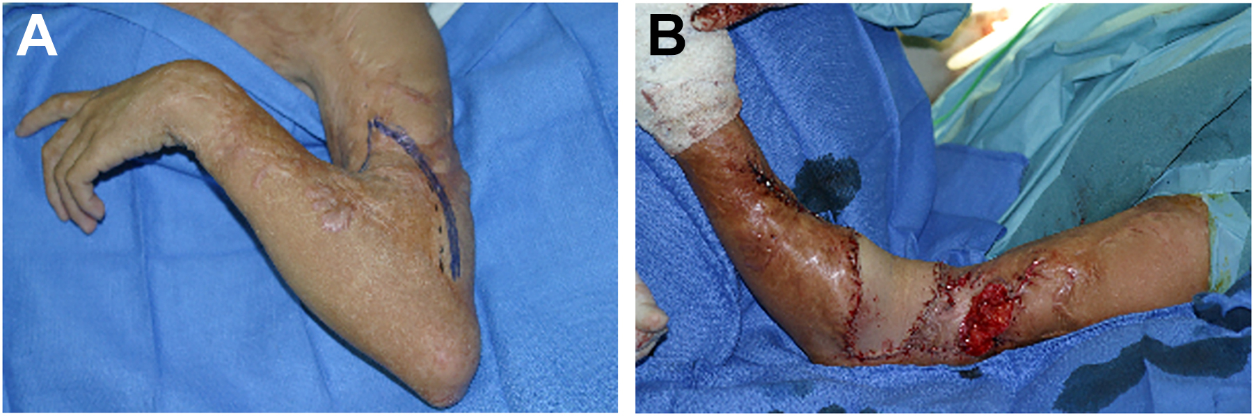 Two photographs show a severe burn contracture of the arm at the antecubital fossa before and after surgical release and flap coverage with anterolateral thigh tissue.