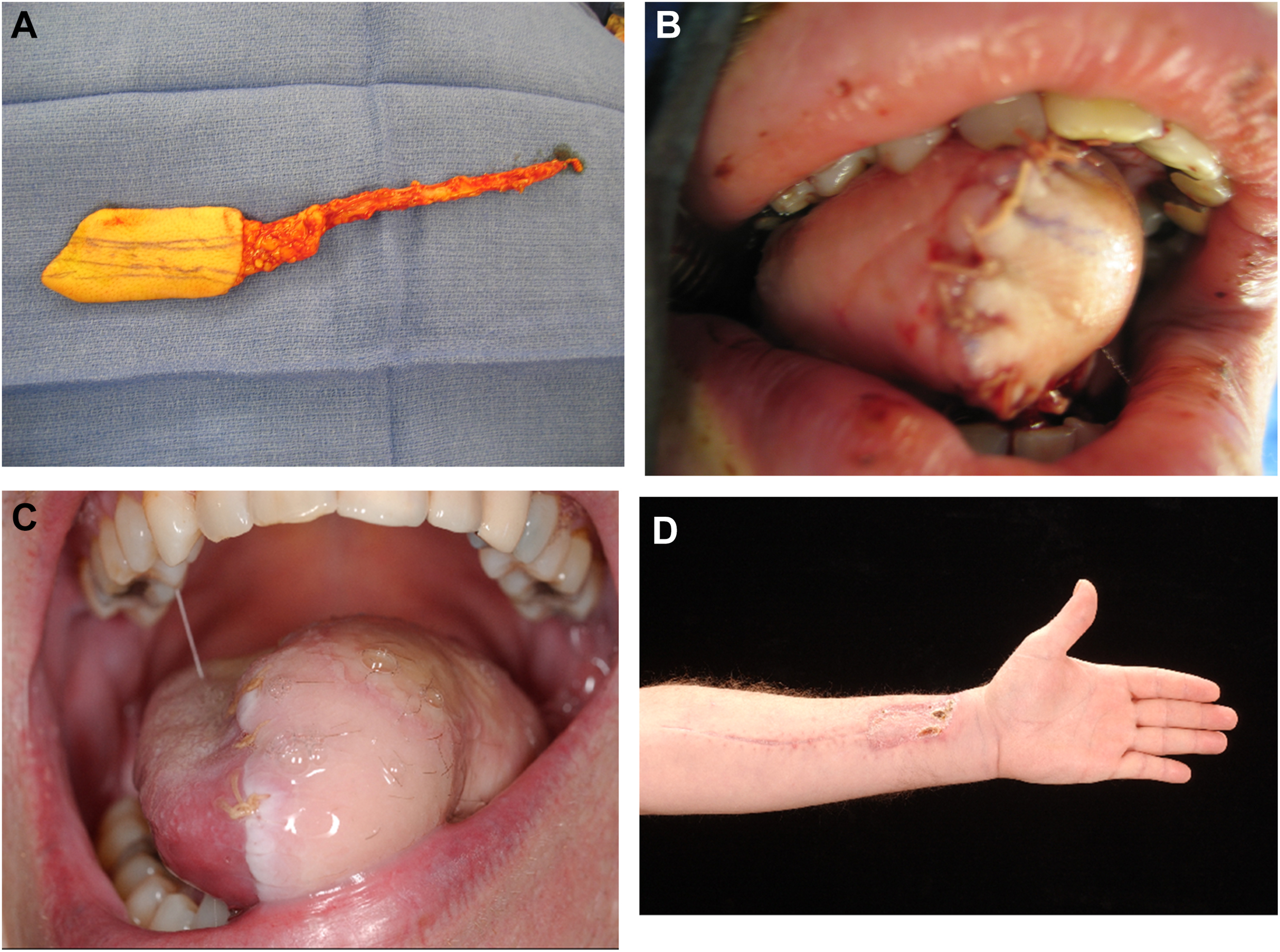 Four clinical photos show a radial forearm flap procedure.