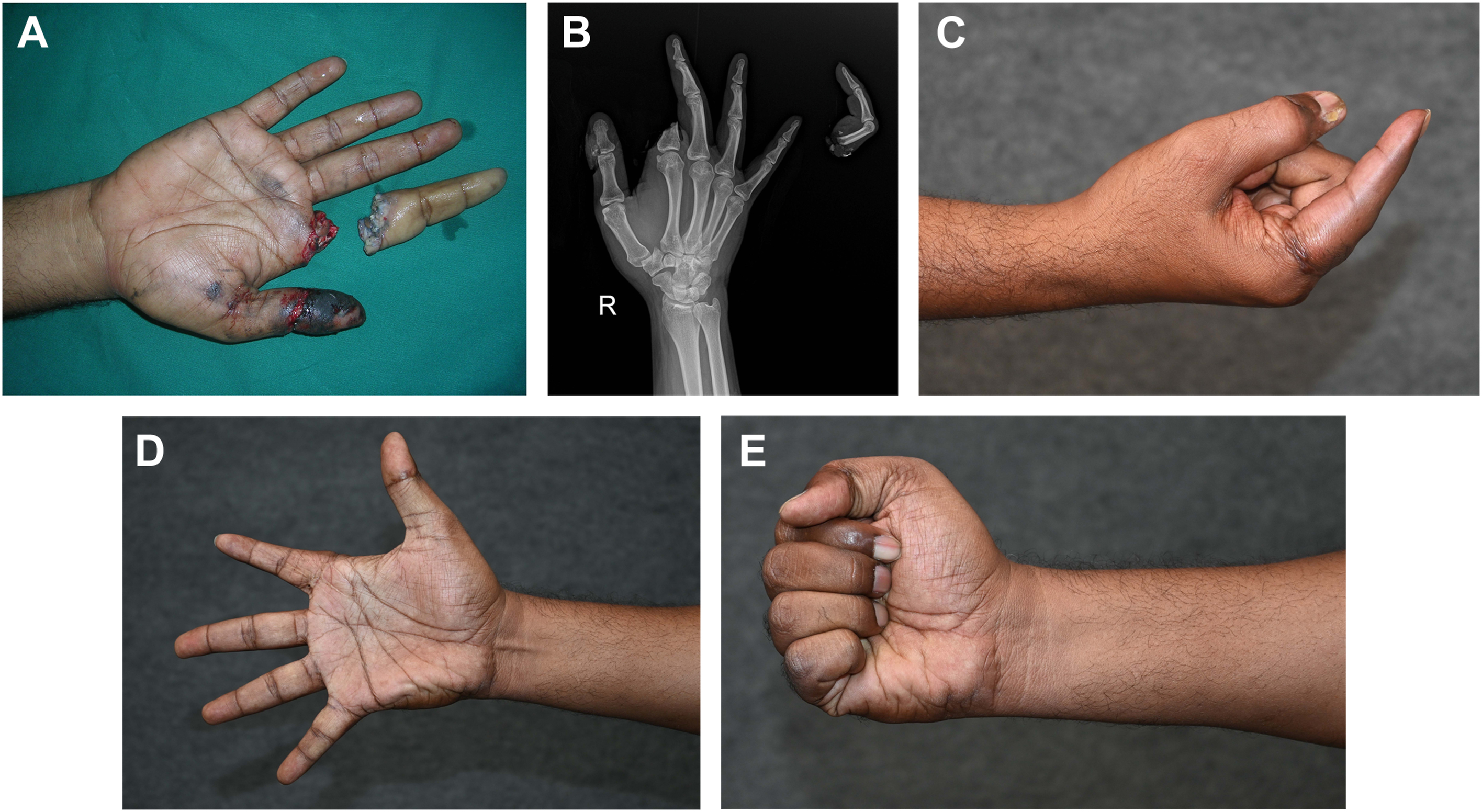 Five panels show total amputation of the right index finger in Zone 2, replantation, and functional recovery with a full range of motion after tendon surgery.