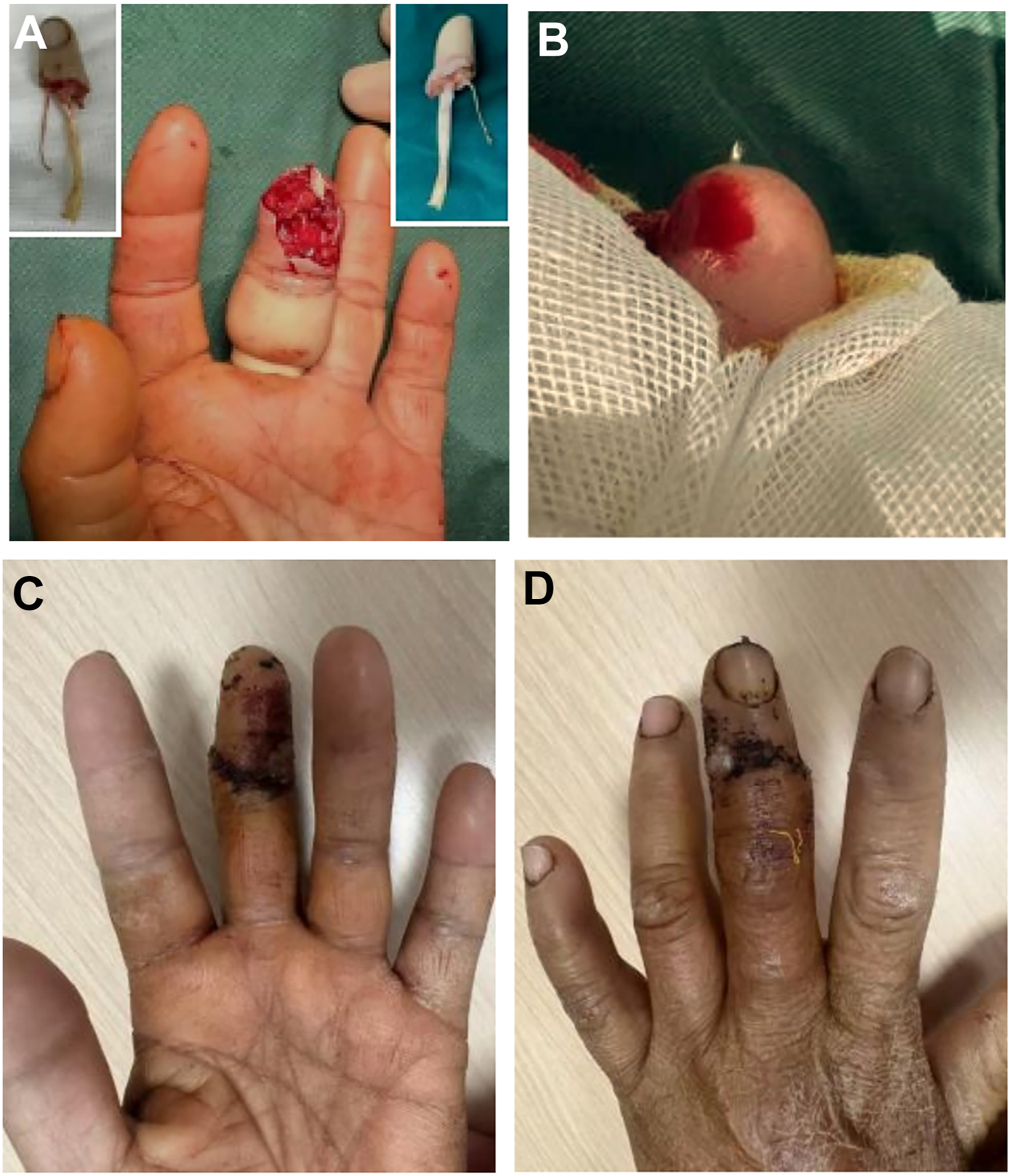 Four clinical photos of a finger surgery, showing before, immediately after, and three weeks after the procedure.