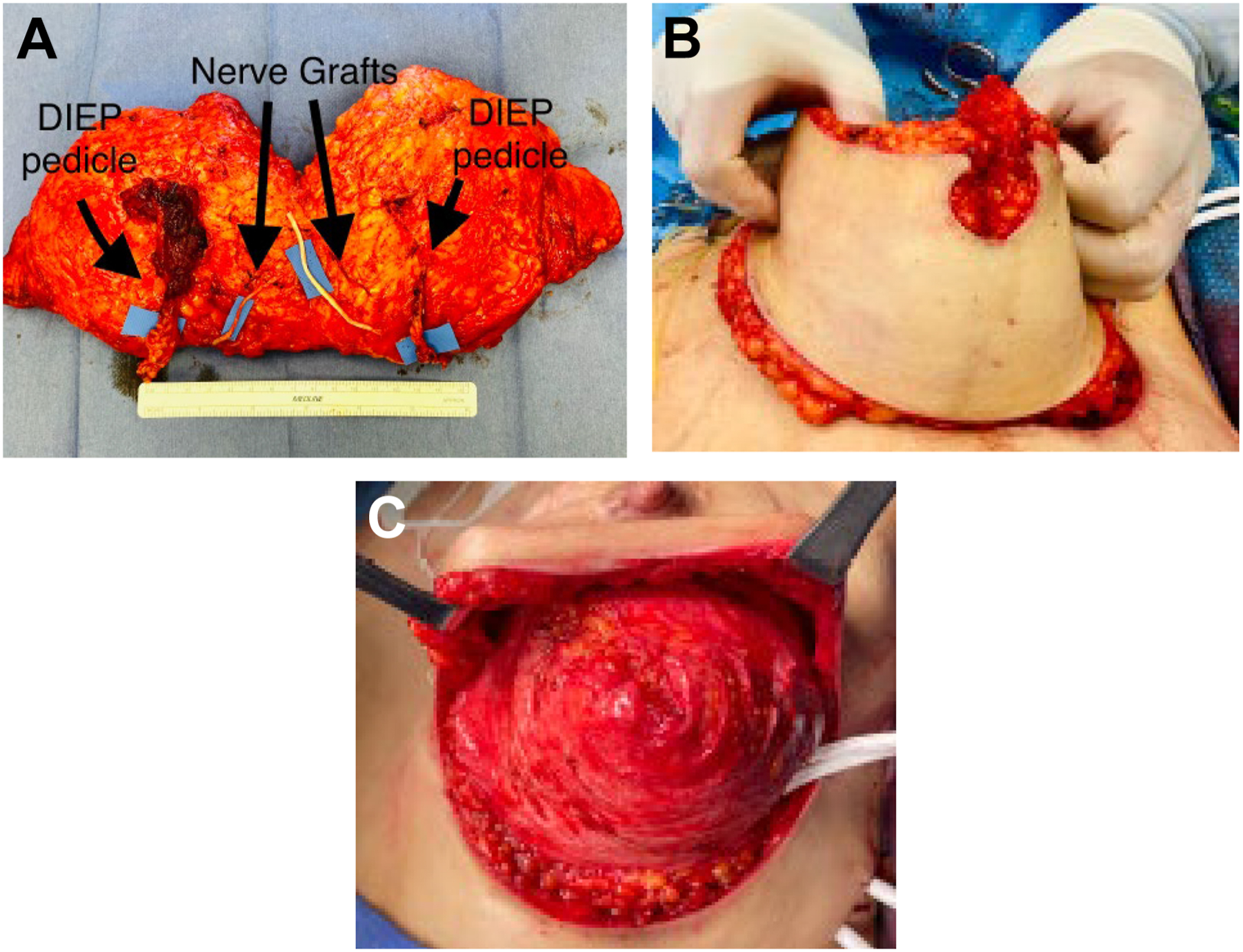 Three surgical photos show the steps of a bipedicled D I E P flap breast reconstruction.