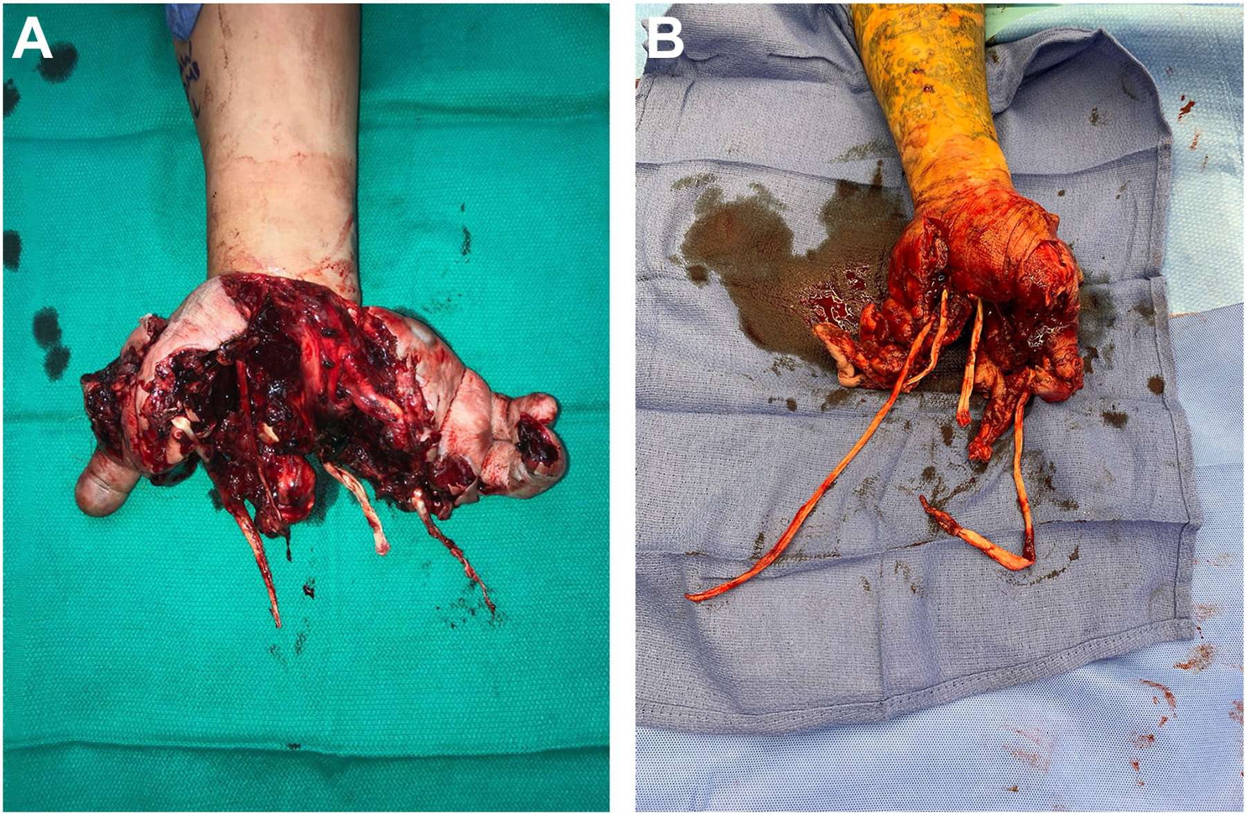 Two clinical photos show a severe, mutilated hand injury with exposed tissues and bone, too complex for initial emergency room evaluation.
