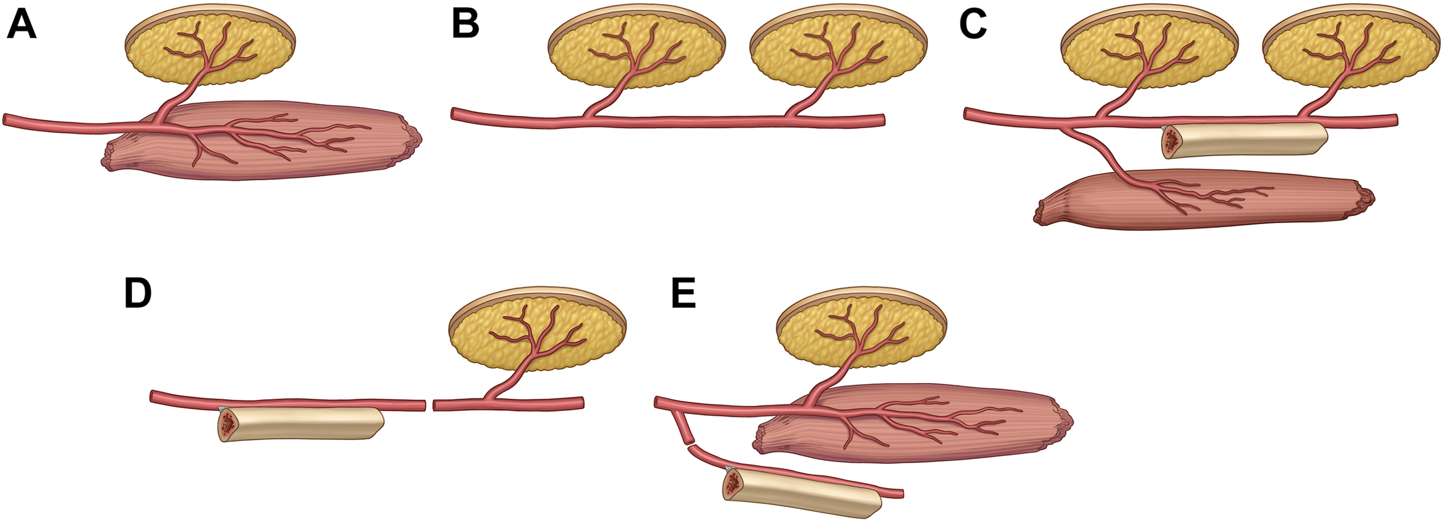 A series of five anatomical diagrams shows different ways a chimeric flap can be used in reconstructive surgery.