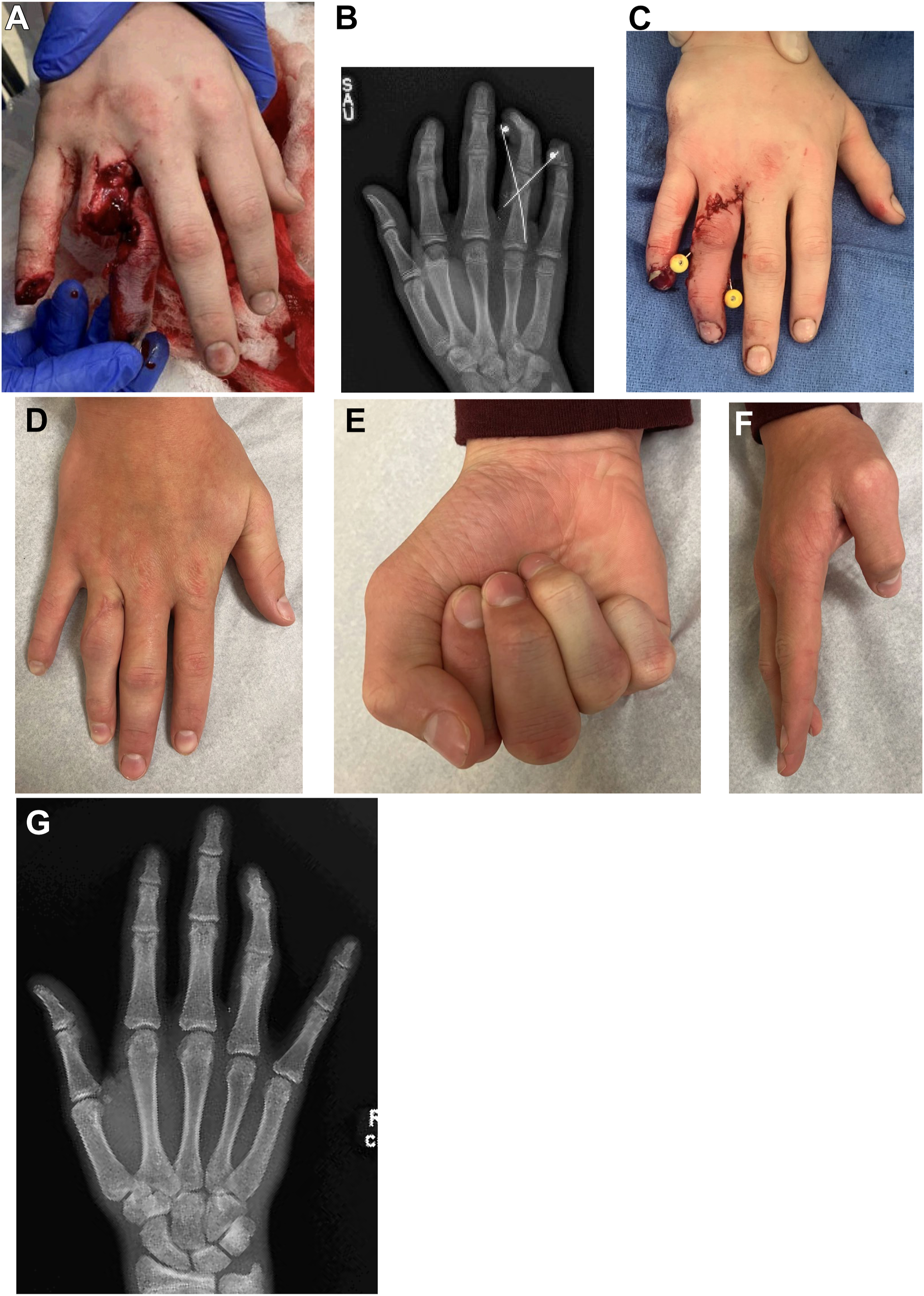 A clinical series shows a traumatic hand injury, surgical repair, radiographs, and follow-up photos demonstrating recovery and finger mobility.