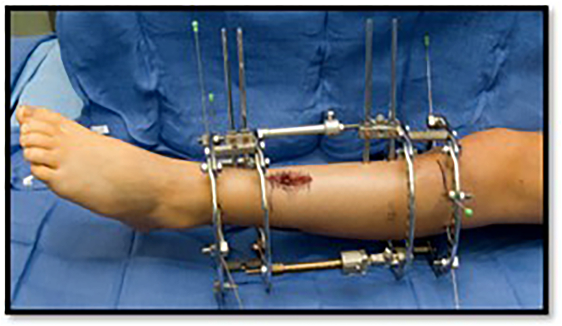 A leg stabilized with an external fixation device showing circular frames and rods securing the bone after surgery or fracture.