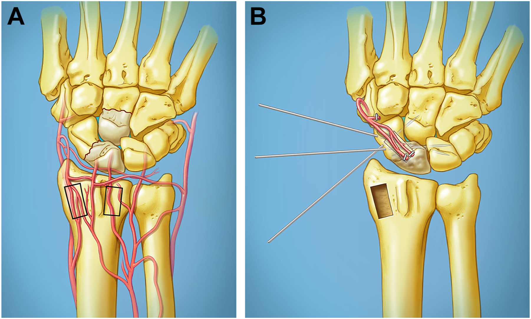 Two illustrations of the wrist show vascularized bone grafting, showing donor site selection and graft placement for reconstruction of the scaphoid.