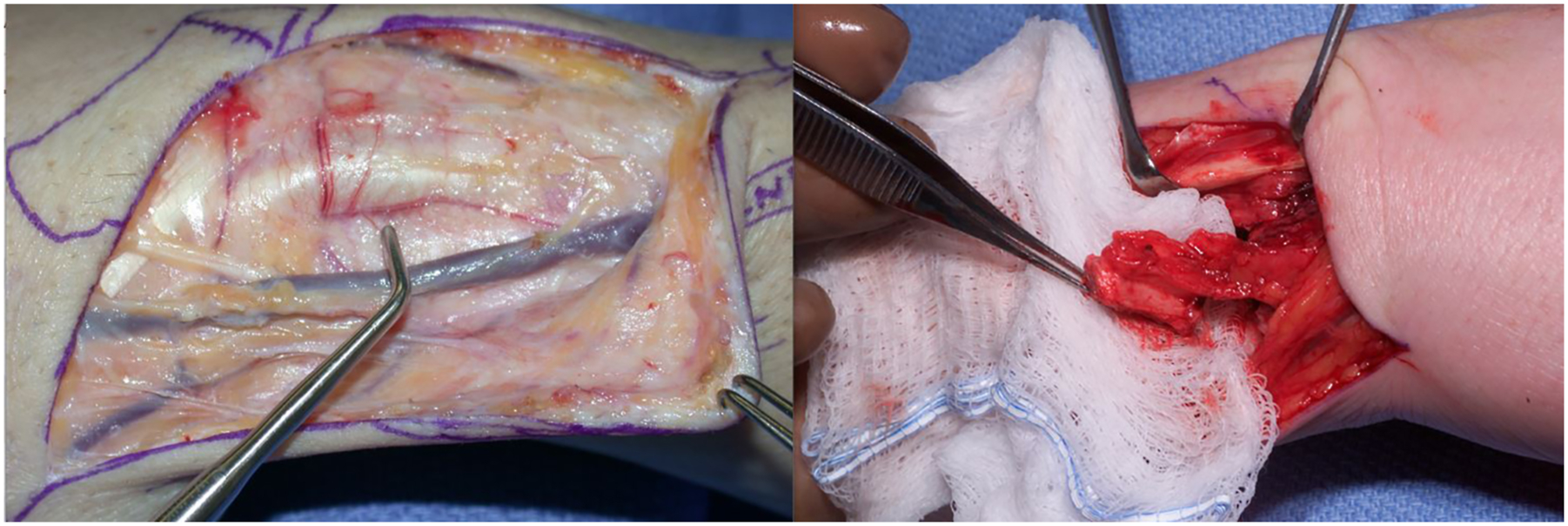 Two surgical photos show the exposure of a vascular pedicle and harvested bone segments prepared for grafting in reconstructive surgery.
