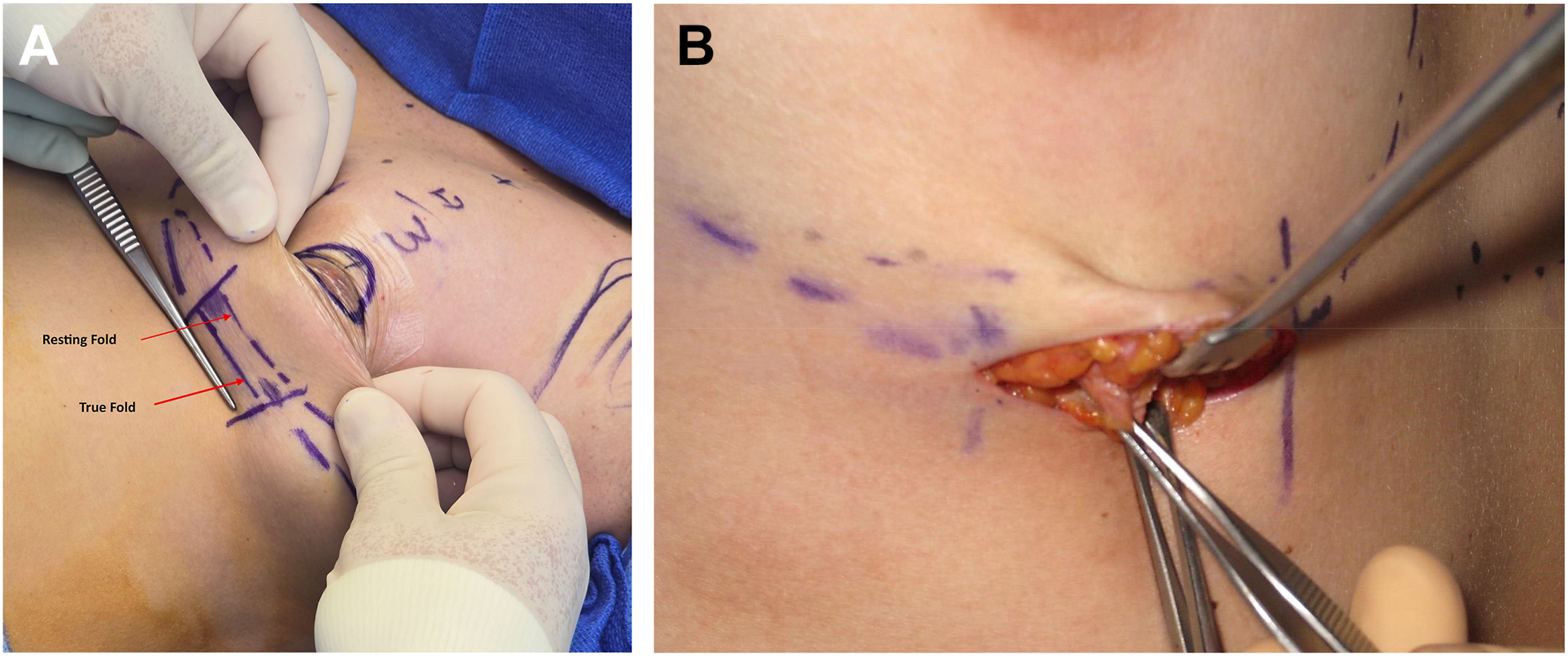 A set of two photographs shows the marking and identification of the resting fold and the true fold on a patient's breast before a surgical procedure.