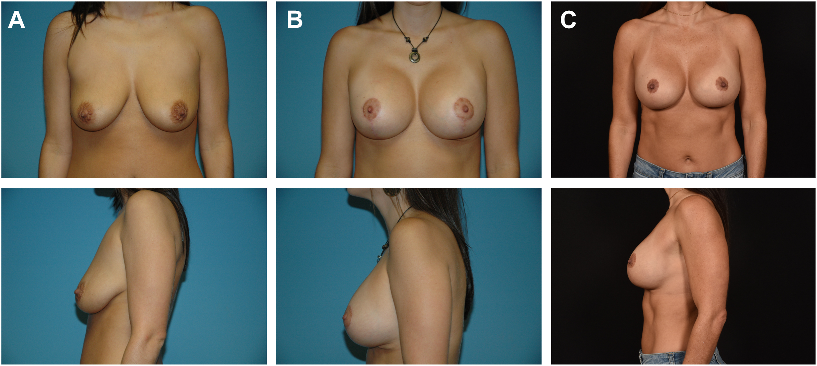 A set of photographs shows a woman before and after breast augmentation and mastopexy in front and side views.