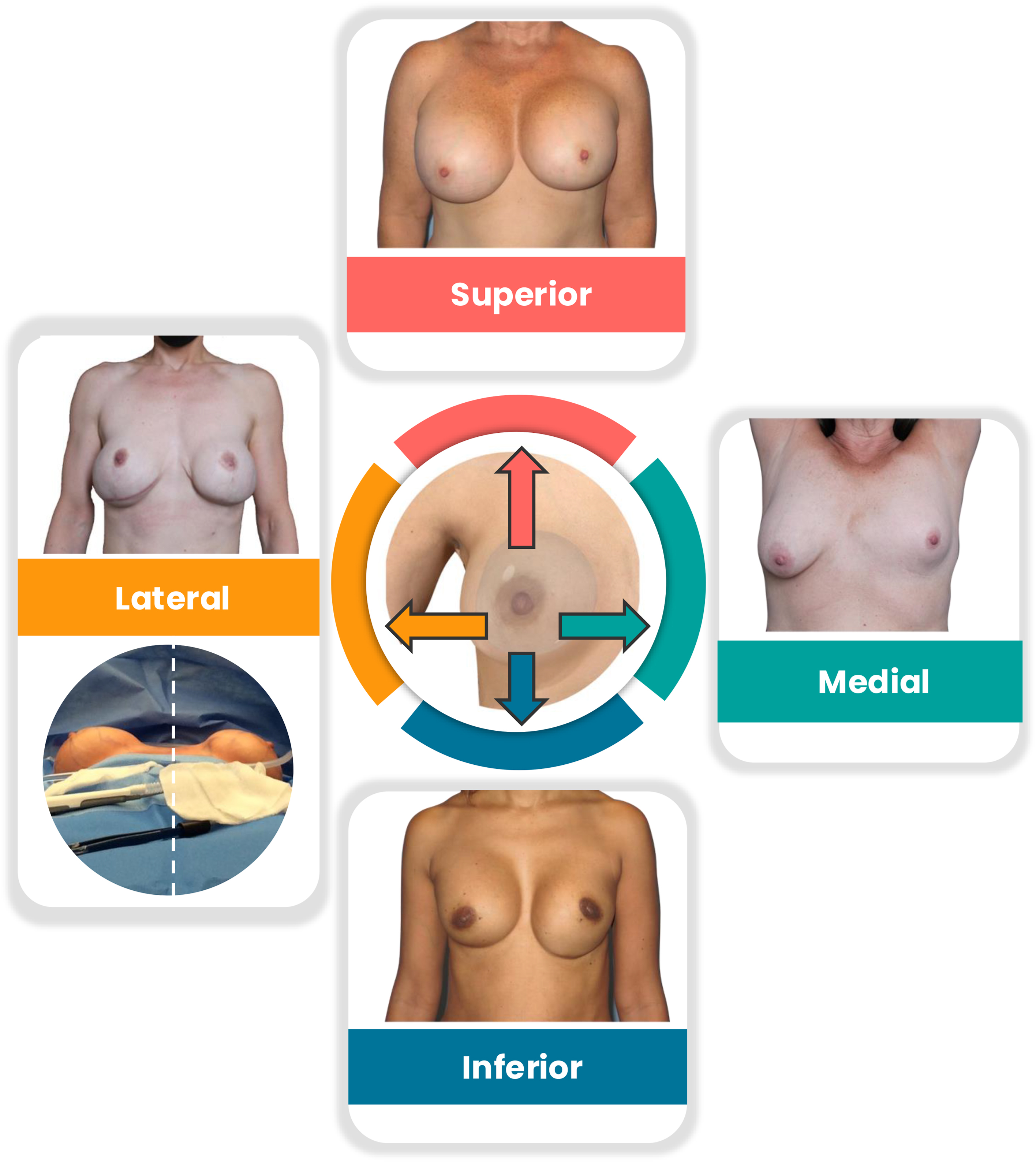 A diagram shows the classification of breast implant malposition. A central diagram of a breast points to four types, superior, inferior, medial, and lateral, each illustrated with a photograph.
