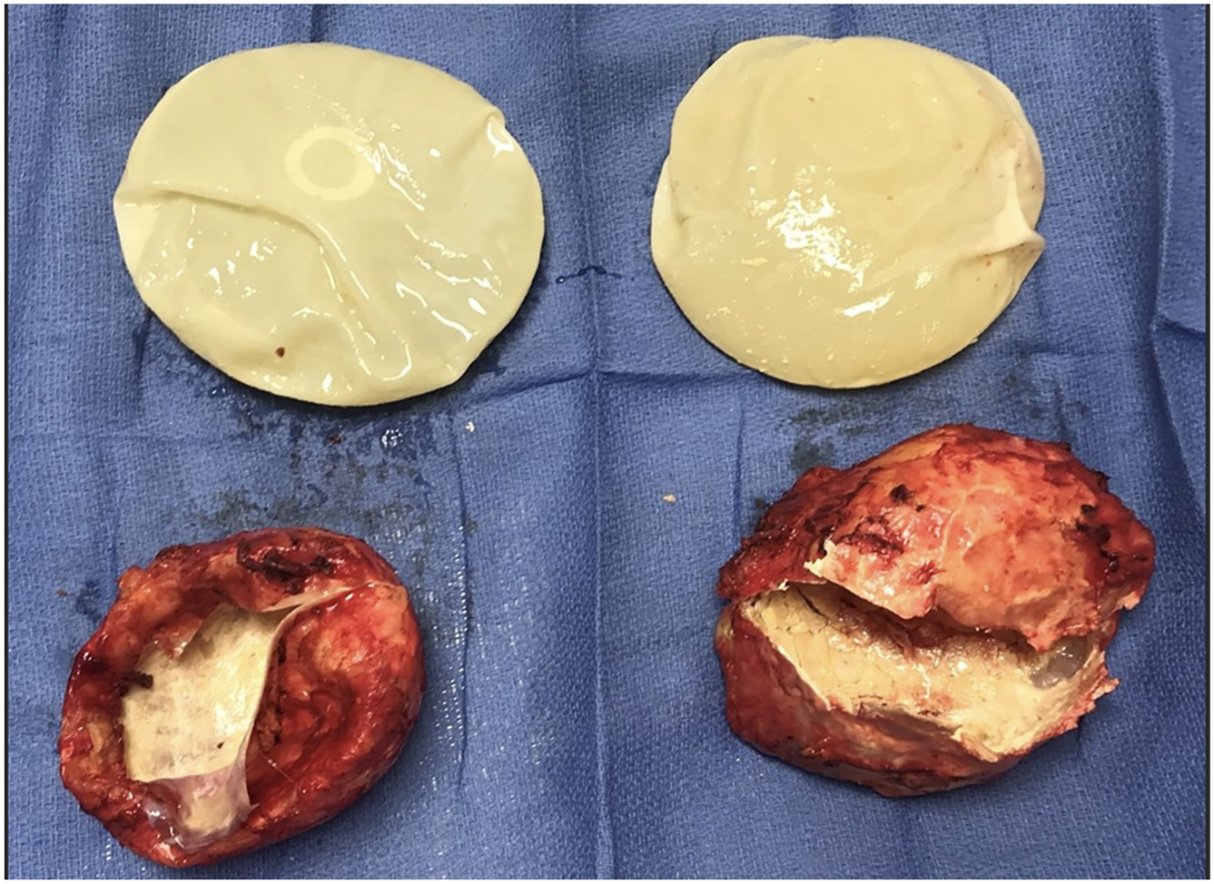 A pair of breast implants and their corresponding tissue capsules are displayed side by side on a surgical drape.