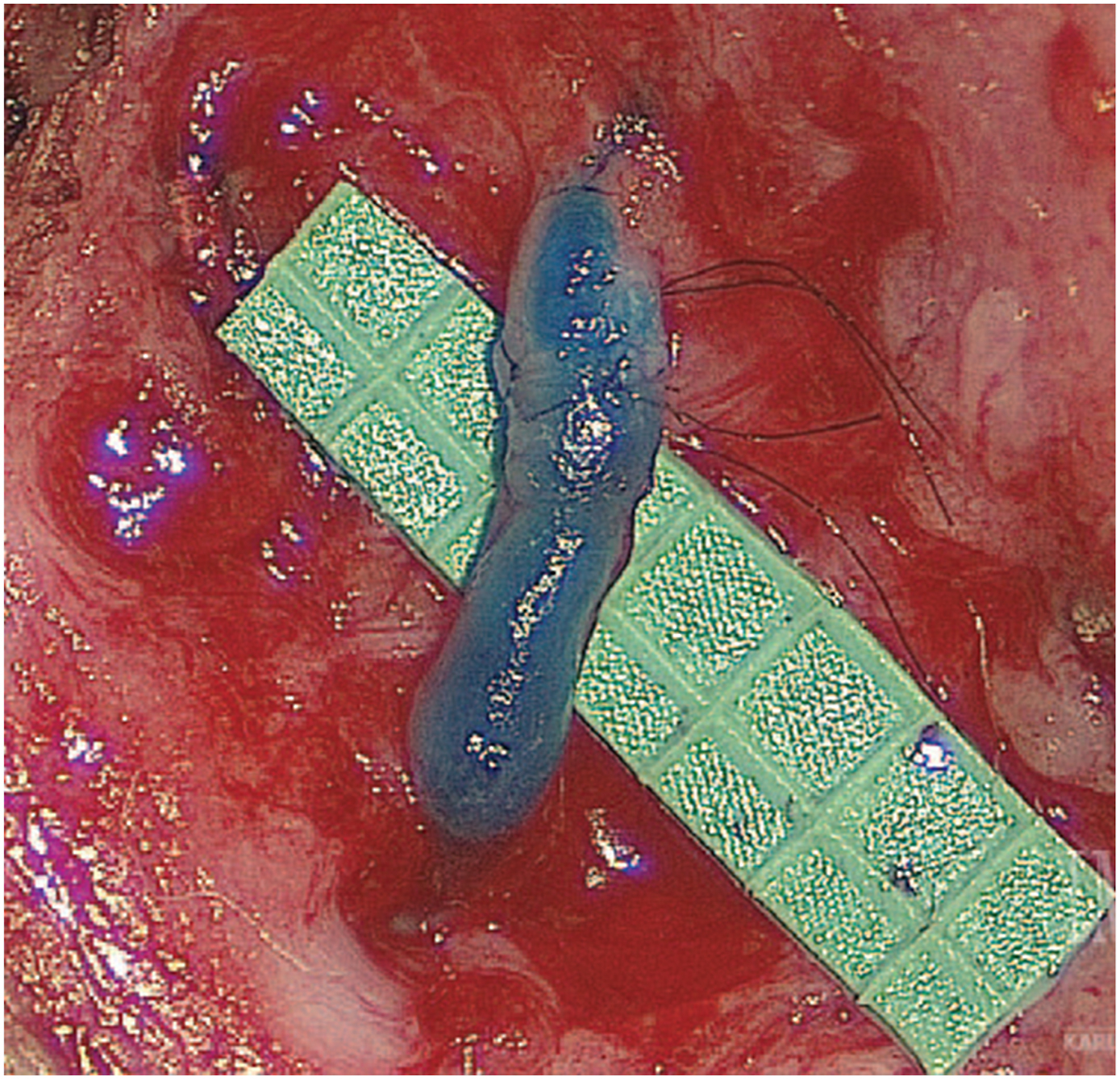 A surgical photo shows a small vein graft with sutures placed over a supporting grid during microsurgical reconstruction.